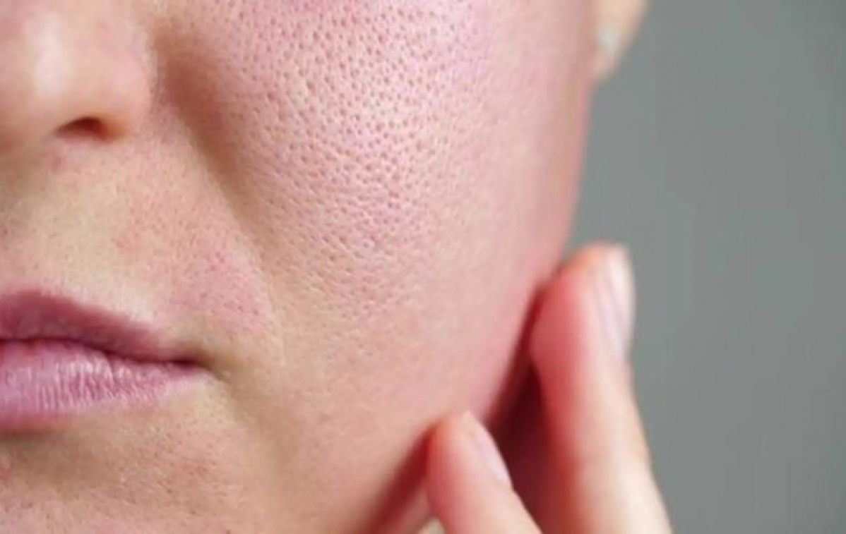 چگونه منافذ پوست را قبل از آرایش ببندیم؟
